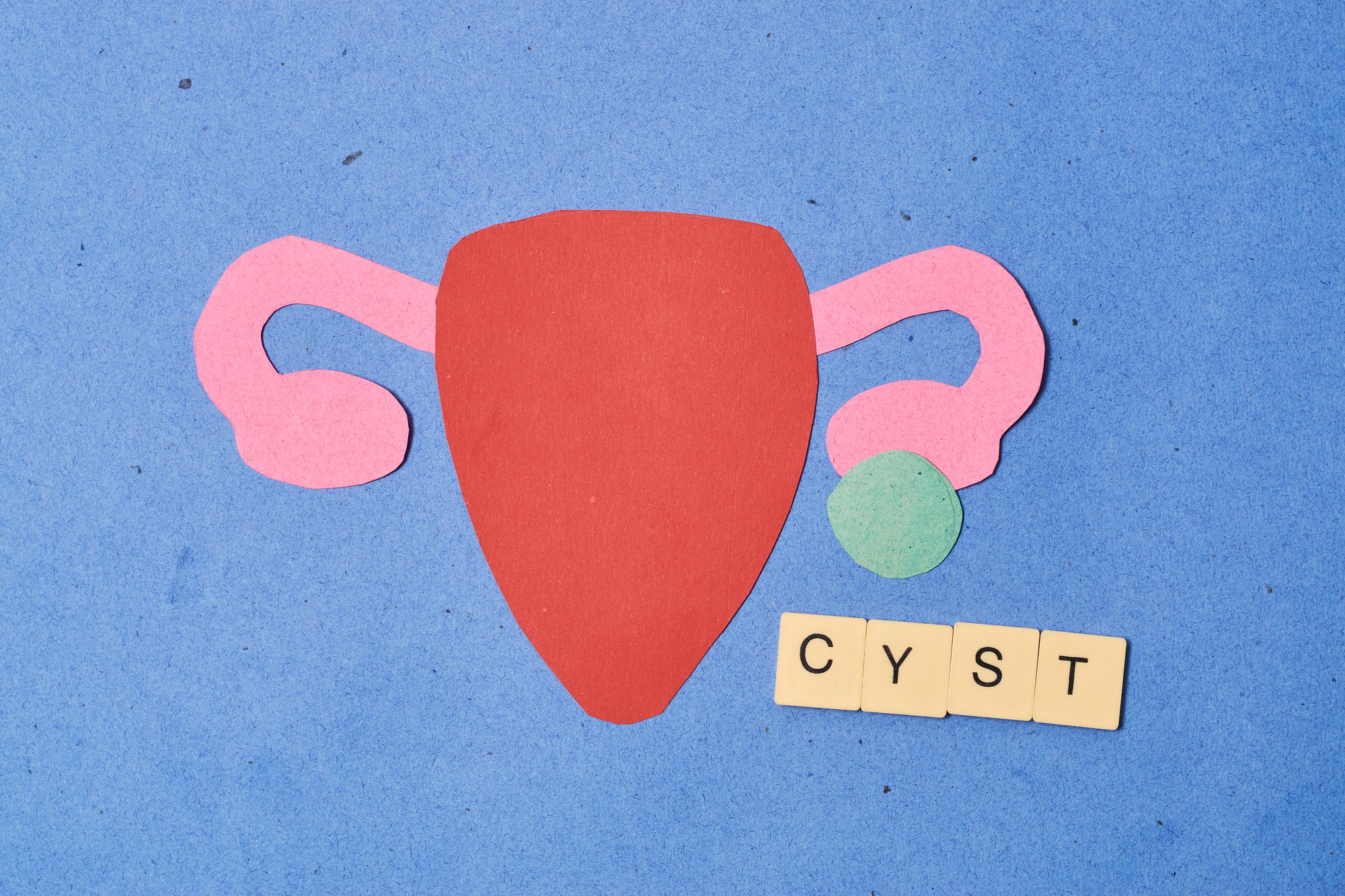 Female uterus made of paper with cyst. Concept Ovarian cyst.