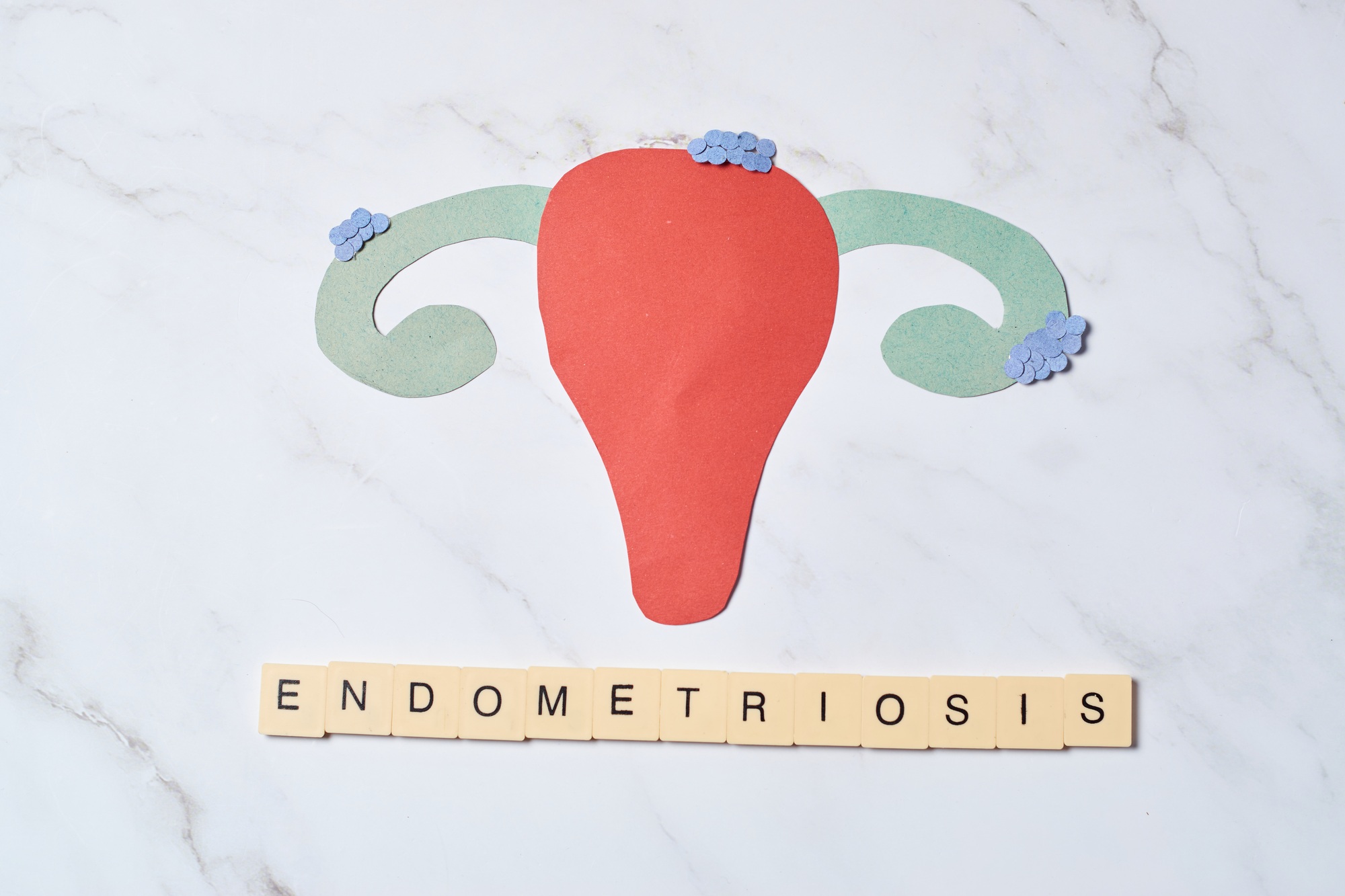 Female uterus with endometriosis, female wellness care concept
